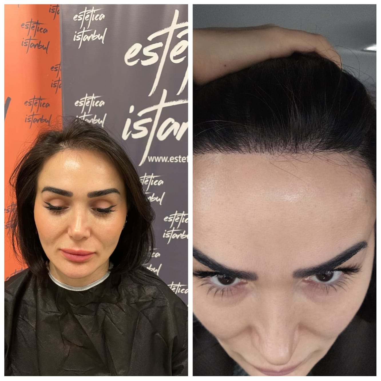 Kadın Saç Ekimi - The Hair Clinic