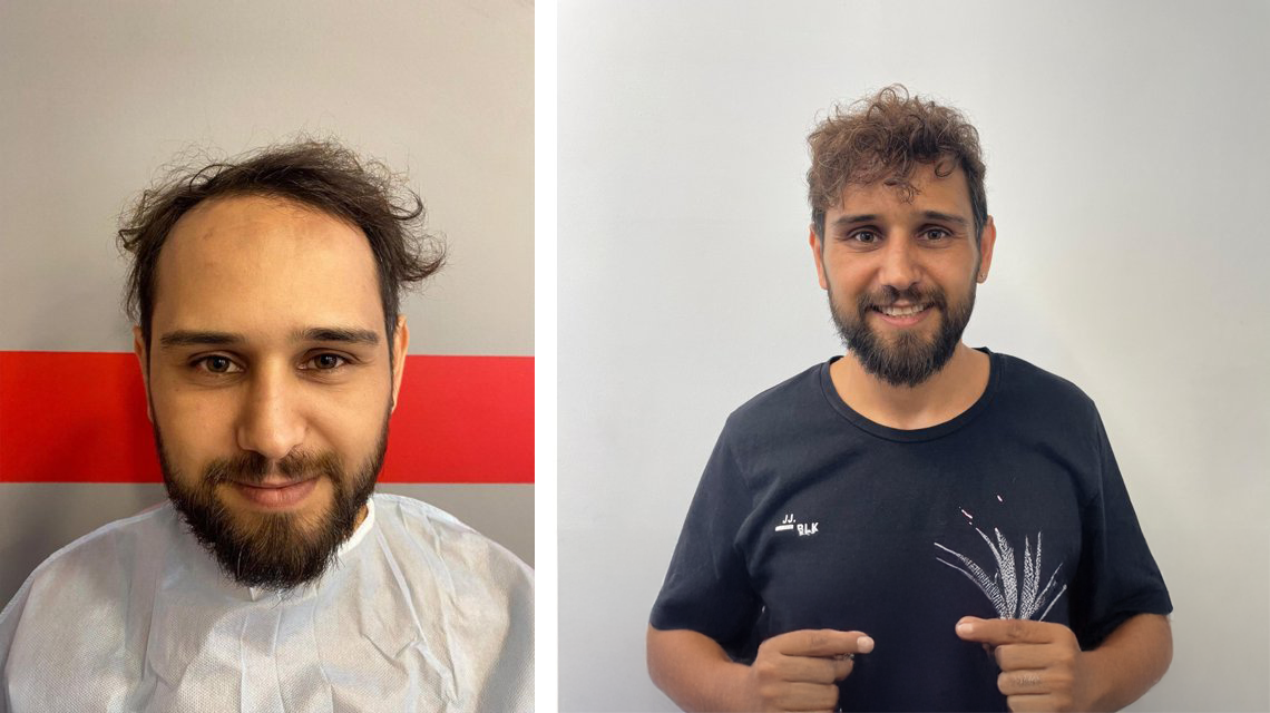 Saç Ekimi Öncesi ve Sonrası - The Hair Clinic